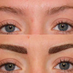 Eyebrows-transplant-1