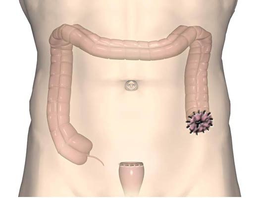 Со стомой кишечника. Колостома операция Гартмана. Колостома непроходимость.