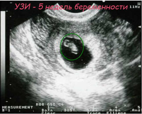 5 недель как выглядит эмбрион беременности фото
