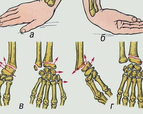 Карта вызова перелом лучезапястного сустава закрытый