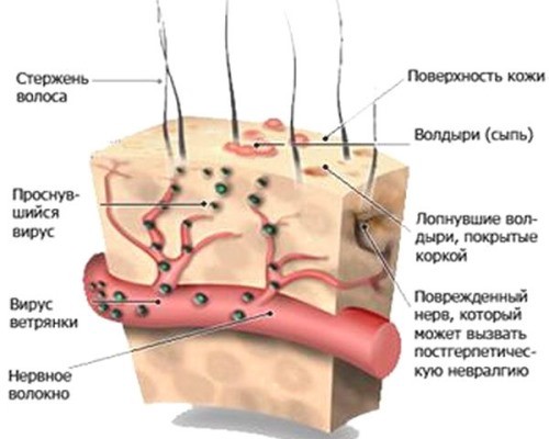 Ветряная оспа микробиология презентация